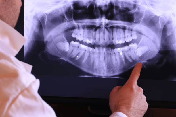 Best Emergency Wisdom Teeth Removal in Salem Lakes, WI